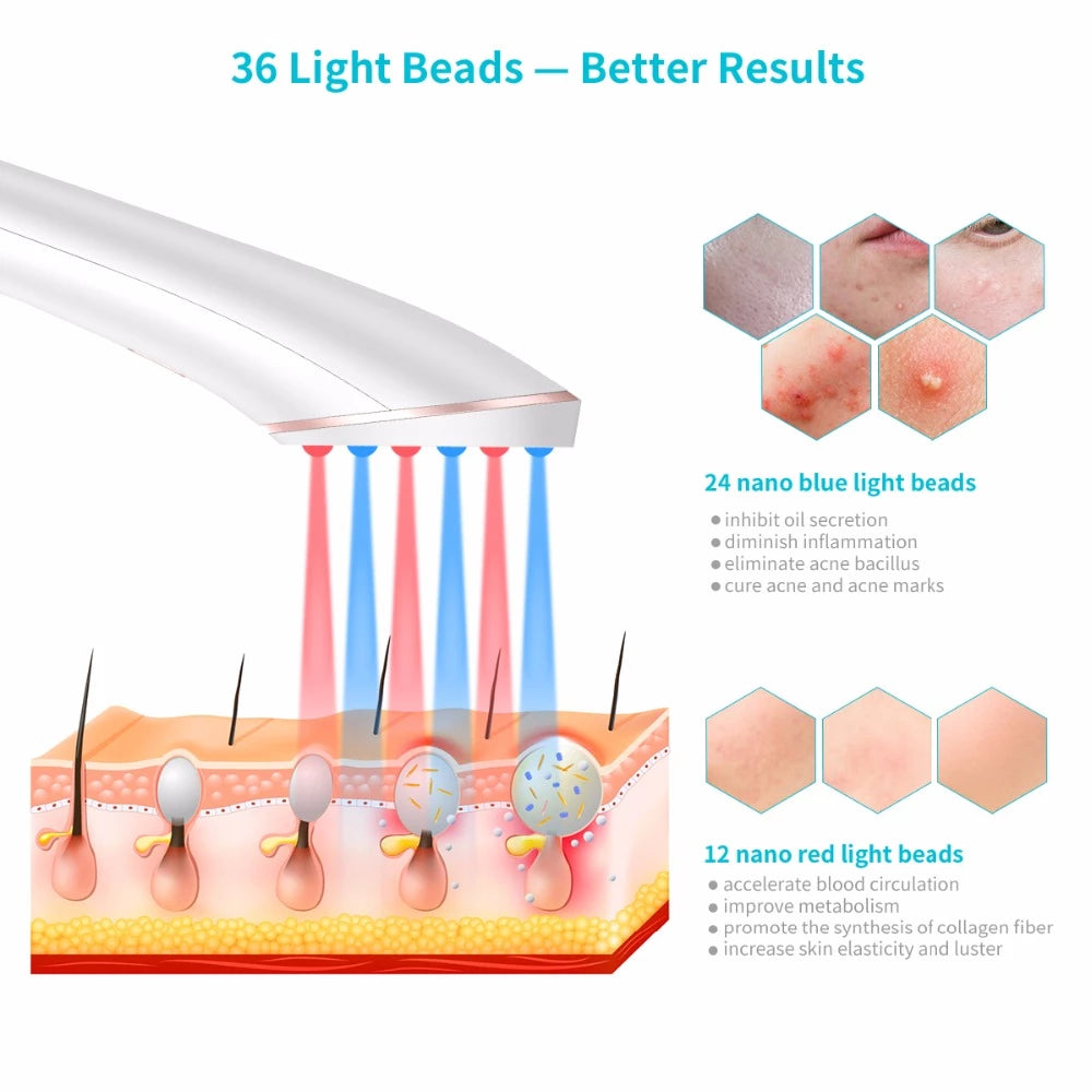 Akne-Lichttherapie Xpreen Kabelloses, wiederaufladbares Aknebehandlungsgerät Akne-Clear-Eraser mit blauem und rotem Licht